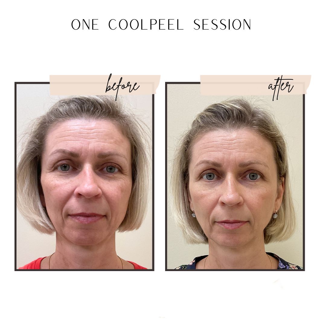 Before and After Image: One CoolPeel Session - front